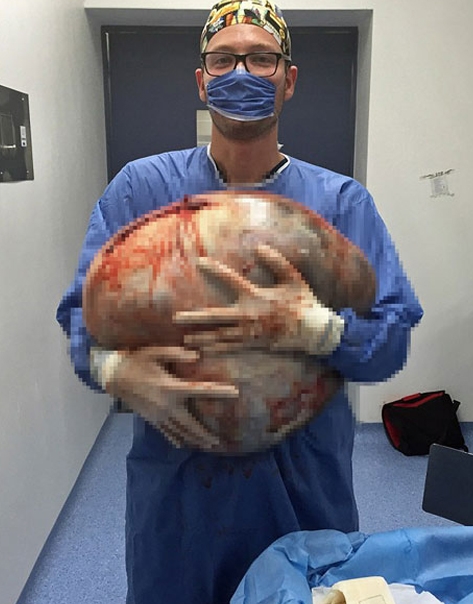 Göbek zannetti ama içinden çıkan şoke etti 5