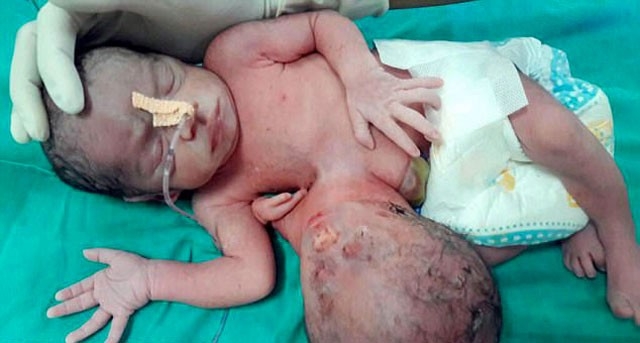 Yeni doğan bebeğin karnından çıkan doktorları şoke etti! 1