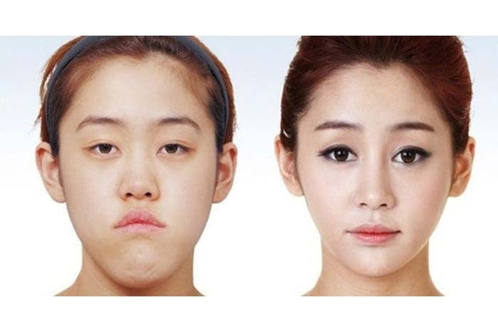 Korelilerin estetik çılgınlığı sonucu büyük değişimleri! 18