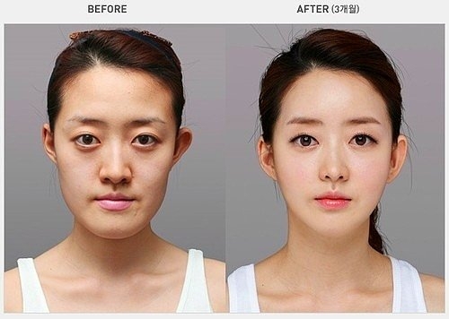 Korelilerin estetik çılgınlığı sonucu büyük değişimleri! 22