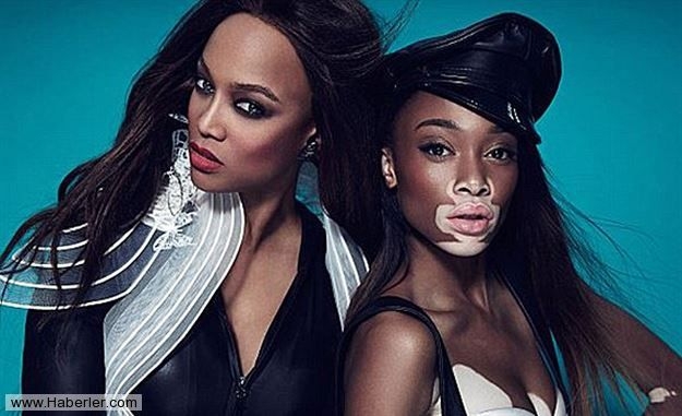 Vitiligo hastası iki renkli manken, özgüveniyle kendine hayran bırakıyor! 75
