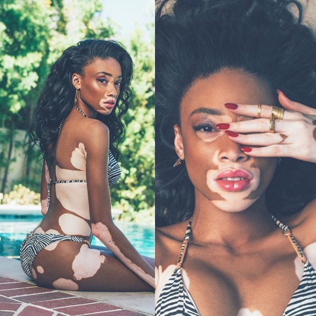 Vitiligo hastası iki renkli manken, özgüveniyle kendine hayran bırakıyor! 40