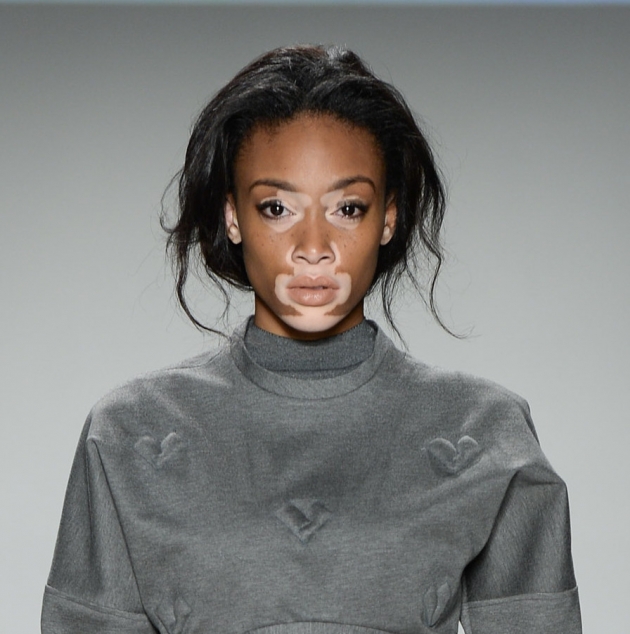 Vitiligo hastası iki renkli manken, özgüveniyle kendine hayran bırakıyor! 32