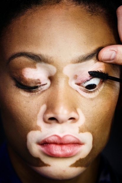 Vitiligo hastası iki renkli manken, özgüveniyle kendine hayran bırakıyor! 28