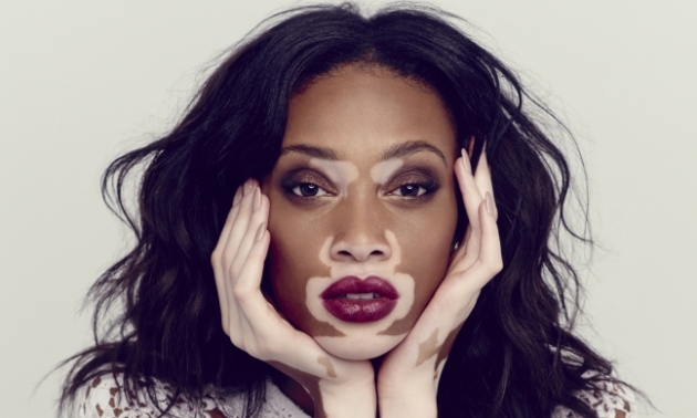 Vitiligo hastası iki renkli manken, özgüveniyle kendine hayran bırakıyor! 79