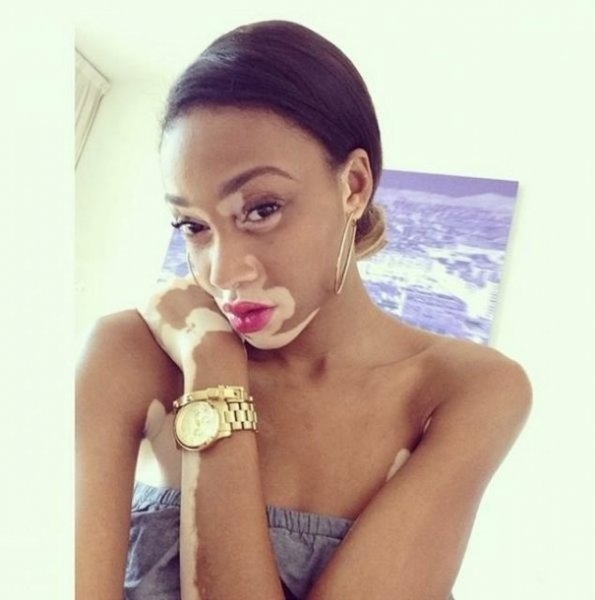 Vitiligo hastası iki renkli manken, özgüveniyle kendine hayran bırakıyor! 2