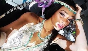 Vitiligo hastası iki renkli manken, özgüveniyle kendine hayran bırakıyor! 22