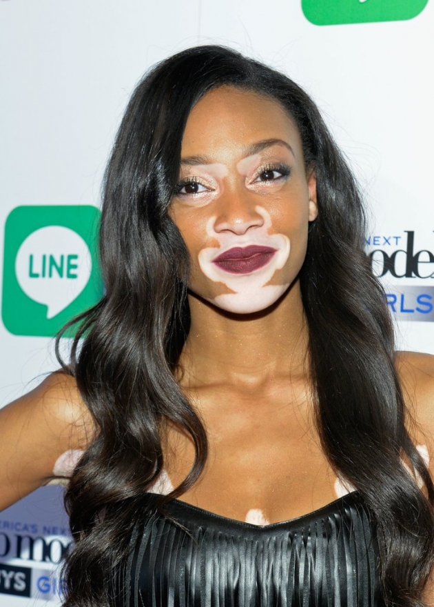 Vitiligo hastası iki renkli manken, özgüveniyle kendine hayran bırakıyor! 25