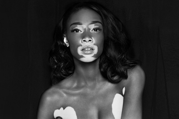 Vitiligo hastası iki renkli manken, özgüveniyle kendine hayran bırakıyor! 48