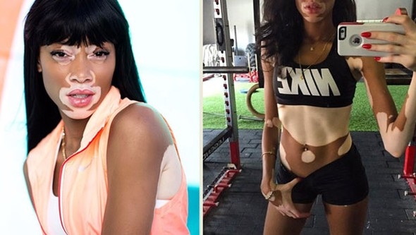Vitiligo hastası iki renkli manken, özgüveniyle kendine hayran bırakıyor! 54