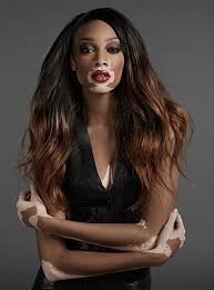 Vitiligo hastası iki renkli manken, özgüveniyle kendine hayran bırakıyor! 36
