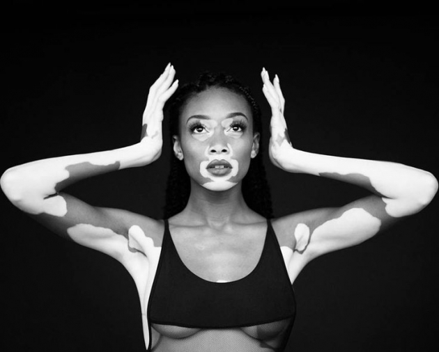 Vitiligo hastası iki renkli manken, özgüveniyle kendine hayran bırakıyor! 51
