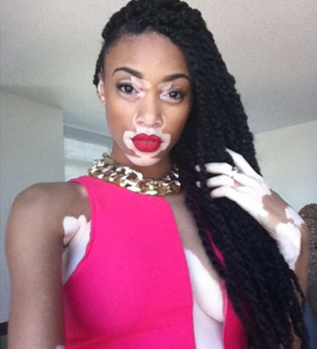 Vitiligo hastası iki renkli manken, özgüveniyle kendine hayran bırakıyor! 41