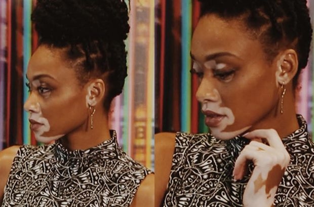 Vitiligo hastası iki renkli manken, özgüveniyle kendine hayran bırakıyor! 3