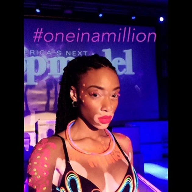 Vitiligo hastası iki renkli manken, özgüveniyle kendine hayran bırakıyor! 16
