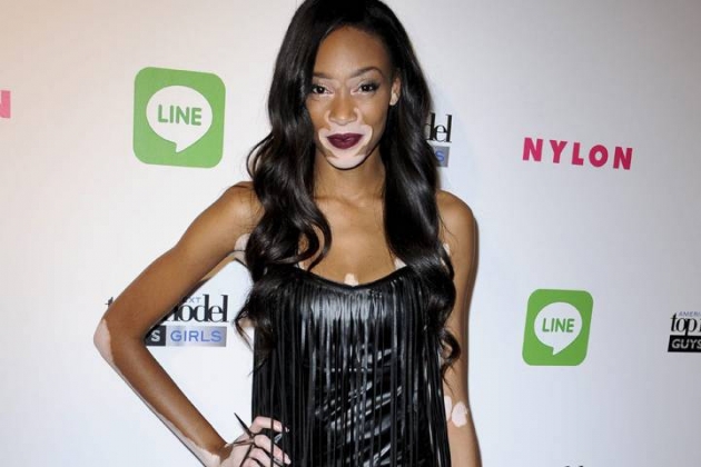 Vitiligo hastası iki renkli manken, özgüveniyle kendine hayran bırakıyor! 6