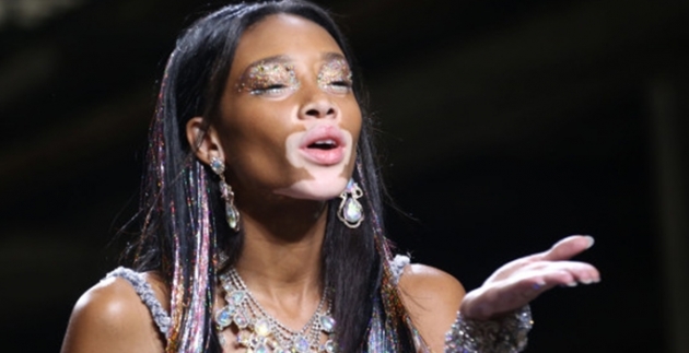 Vitiligo hastası iki renkli manken, özgüveniyle kendine hayran bırakıyor! 78