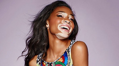Vitiligo hastası iki renkli manken, özgüveniyle kendine hayran bırakıyor! 33