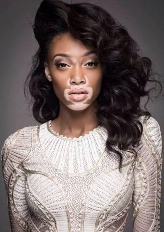 Vitiligo hastası iki renkli manken, özgüveniyle kendine hayran bırakıyor! 9