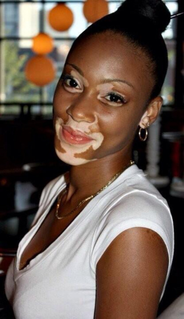Vitiligo hastası iki renkli manken, özgüveniyle kendine hayran bırakıyor! 27