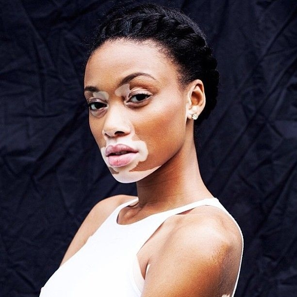 Vitiligo hastası iki renkli manken, özgüveniyle kendine hayran bırakıyor! 31