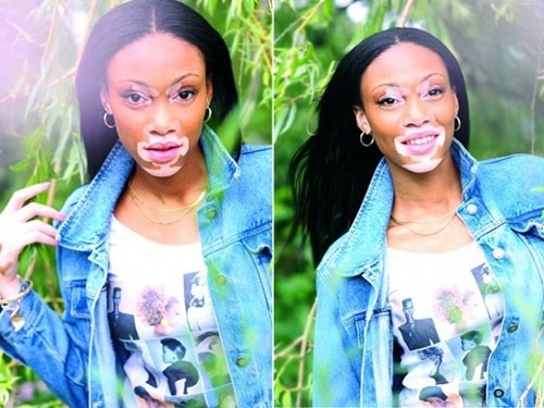 Vitiligo hastası iki renkli manken, özgüveniyle kendine hayran bırakıyor! 61