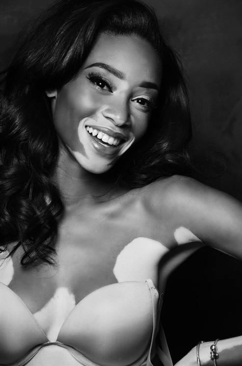 Vitiligo hastası iki renkli manken, özgüveniyle kendine hayran bırakıyor! 43
