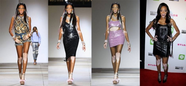 Vitiligo hastası iki renkli manken, özgüveniyle kendine hayran bırakıyor! 19