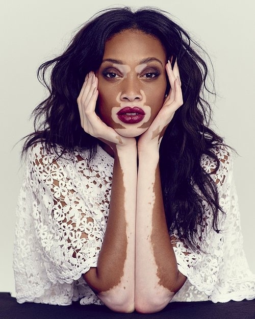 Vitiligo hastası iki renkli manken, özgüveniyle kendine hayran bırakıyor! 76
