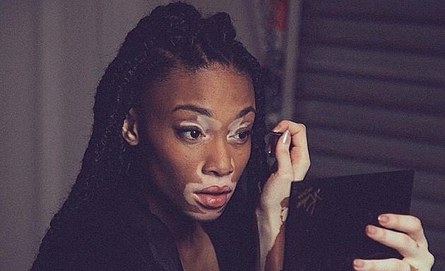Vitiligo hastası iki renkli manken, özgüveniyle kendine hayran bırakıyor! 71
