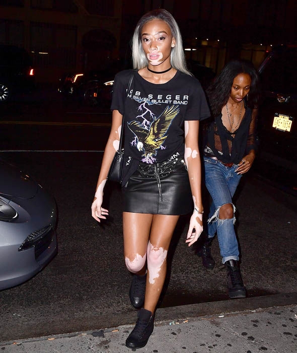 Vitiligo hastası iki renkli manken, özgüveniyle kendine hayran bırakıyor! 8