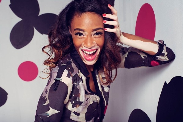 Vitiligo hastası iki renkli manken, özgüveniyle kendine hayran bırakıyor! 44