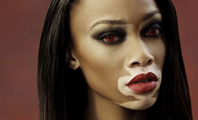 Vitiligo hastası iki renkli manken, özgüveniyle kendine hayran bırakıyor! 77
