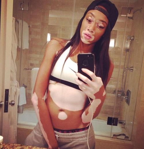 Vitiligo hastası iki renkli manken, özgüveniyle kendine hayran bırakıyor! 59