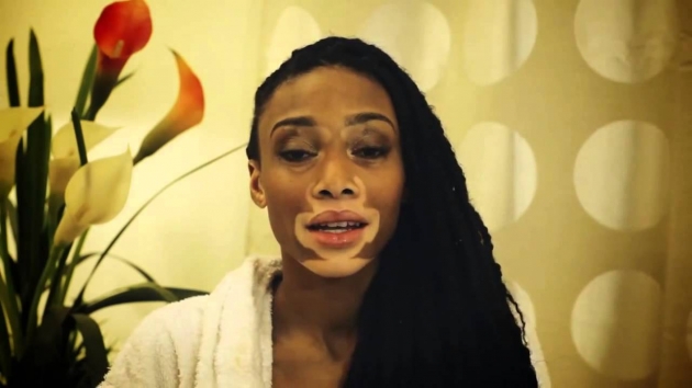 Vitiligo hastası iki renkli manken, özgüveniyle kendine hayran bırakıyor! 21