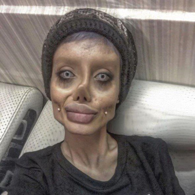 Angelina Jolie'ye benzemek için estetik oldum demişti! 5