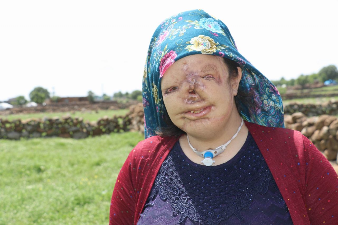 Genç kızın tek dileği yüzünün olması! 4