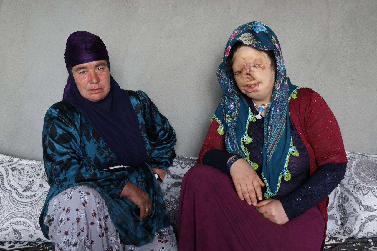 Genç kızın tek dileği yüzünün olması! 2