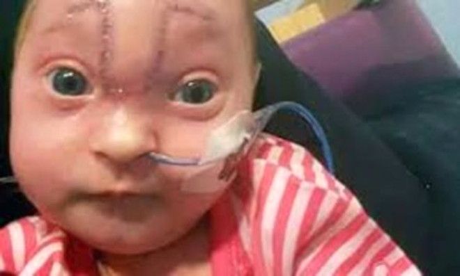 Beyni dışarıda doğan bebeğin yaşam mücadelesi! 5
