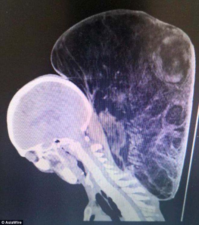 Yaşlı adamın boynundan 15 kiloluk tümör çıkartıldı! 3