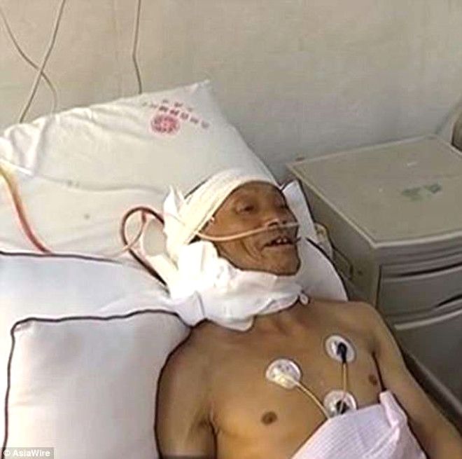 Yaşlı adamın boynundan 15 kiloluk tümör çıkartıldı! 8