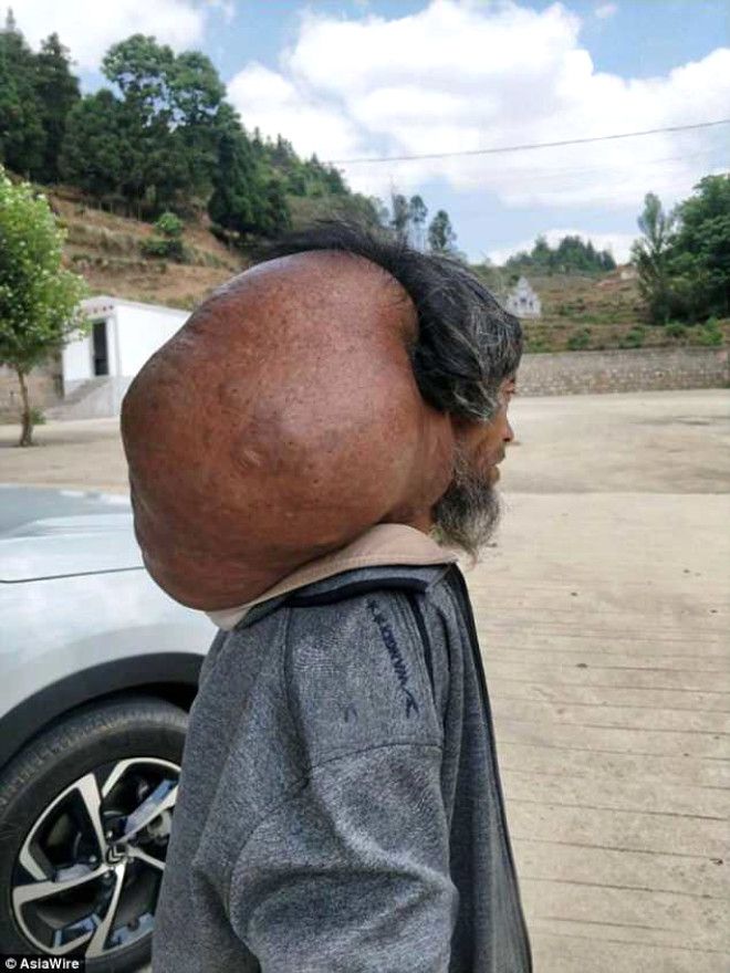 Yaşlı adamın boynundan 15 kiloluk tümör çıkartıldı! 2