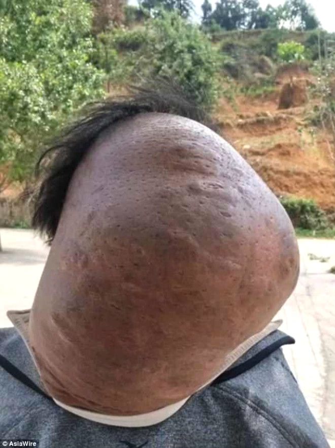 Yaşlı adamın boynundan 15 kiloluk tümör çıkartıldı! 5