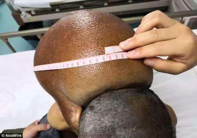 Yaşlı adamın boynundan 15 kiloluk tümör çıkartıldı! 4
