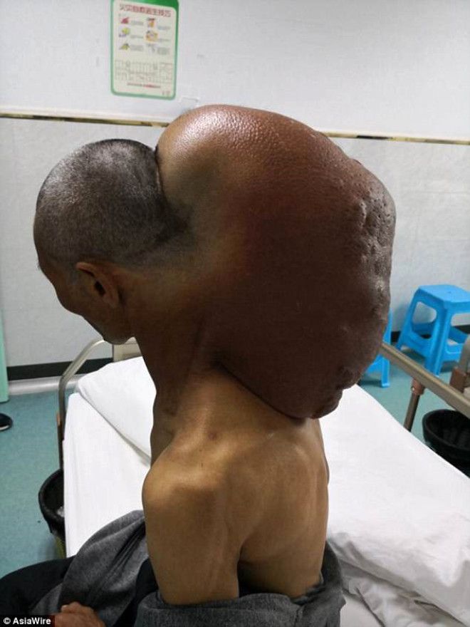 Yaşlı adamın boynundan 15 kiloluk tümör çıkartıldı! 1