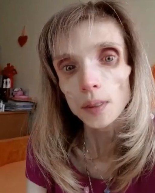 Anoreksiya hastası kadın 17 kilo kaldı! 12