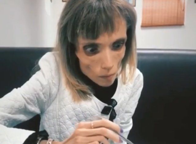 Anoreksiya hastası kadın 17 kilo kaldı! 13