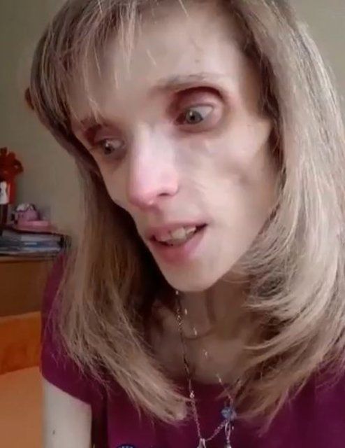 Anoreksiya hastası kadın 17 kilo kaldı! 3