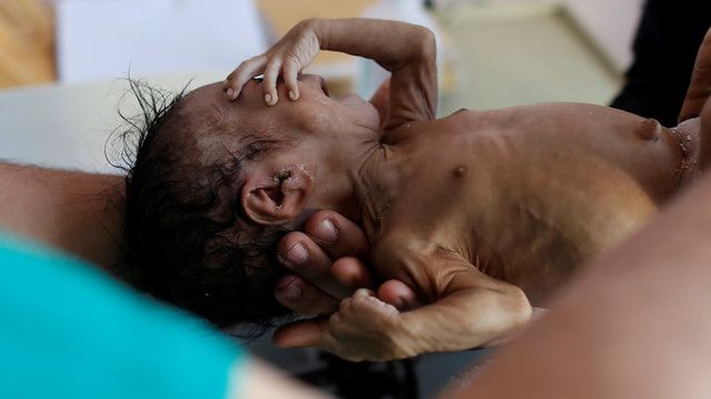 Türkiye Yemen'de ölen çocuklar için ayakta! 2