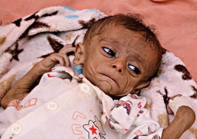 Türkiye Yemen'de ölen çocuklar için ayakta! 25